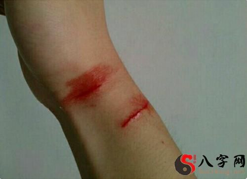 梦见伤口流血